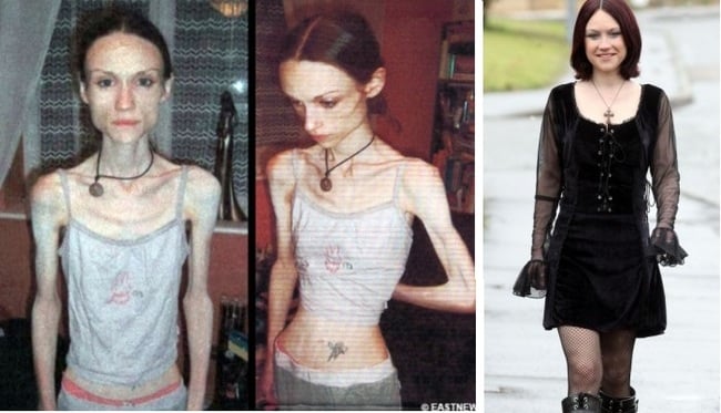 progreso de una chica con anorexia antes durante y después de la enfermedad 