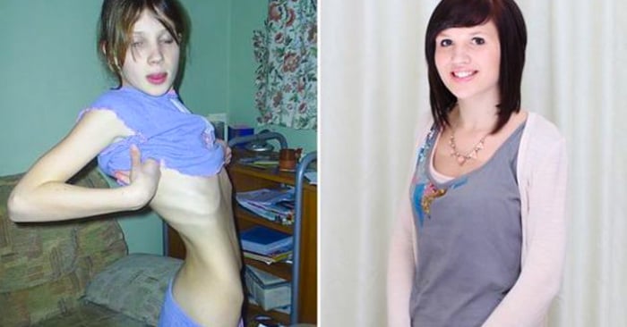 9 Inspiradoras fotos de chicas que superaron la anorexia