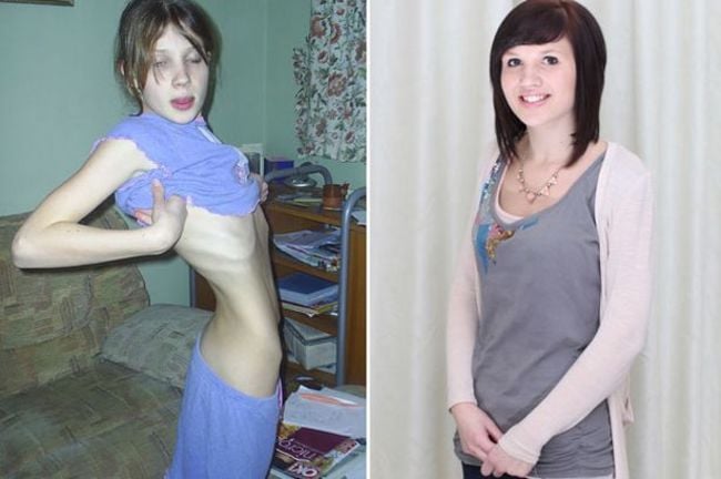 progreso de una chica con anorexia a la derecha se muestra como esta extremamente delgada y a la izquierda se muestra con la ganancia de peso y más saludable 