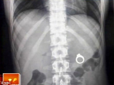 radiografía de el pecho de alguien con un anillo cerca de los pulmones 