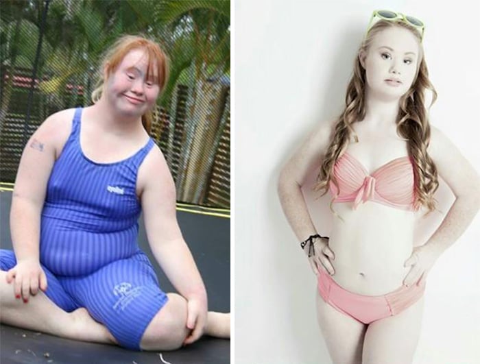 chica con síndrome de down antes y después de adelgazar 