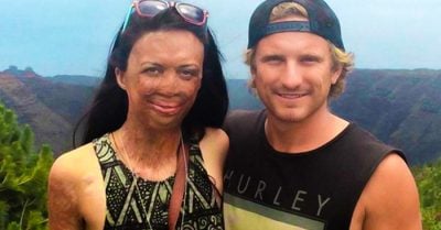 La modelo que se QUEMÓ gran parte de su cuerpo se CASARÁ con su novio de toda la vida