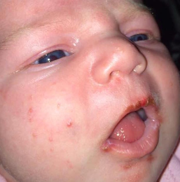 Bebé que se contagio de herpes 