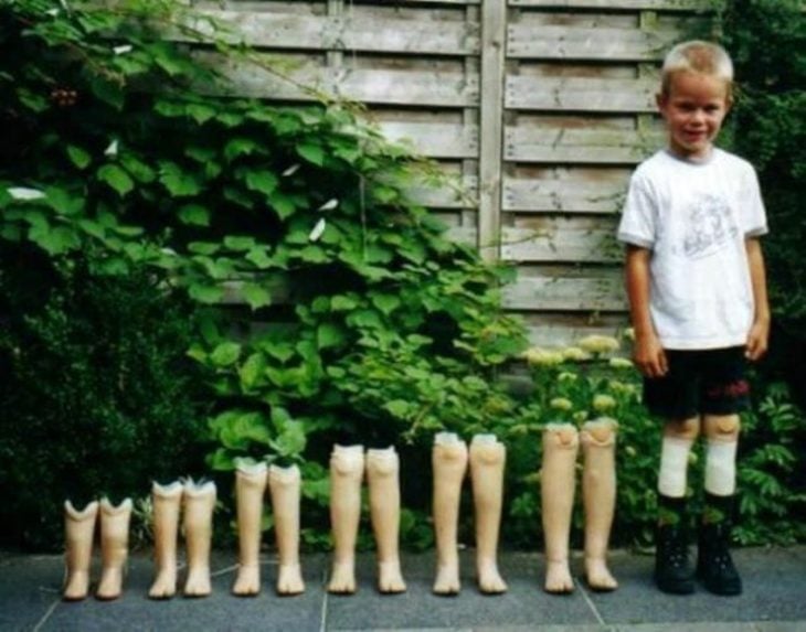 niño con prótesis de piernas de diferentes tamaños