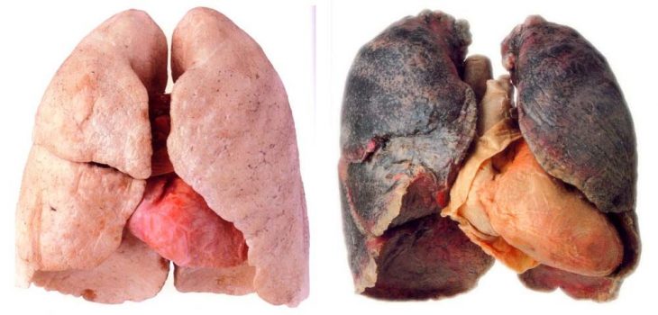 pulmones sanos vs. enfermos