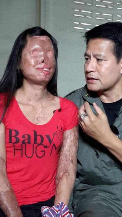 hombre con mujer quemada por ácido