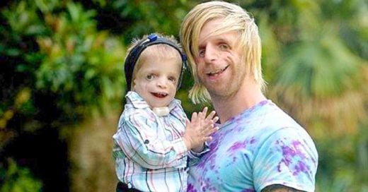 Jono Lancaster de 30 años padece el extraño síndrome Treacher Collins, viajó hasta Australia para conocer a un niño con el mismo padecimiento