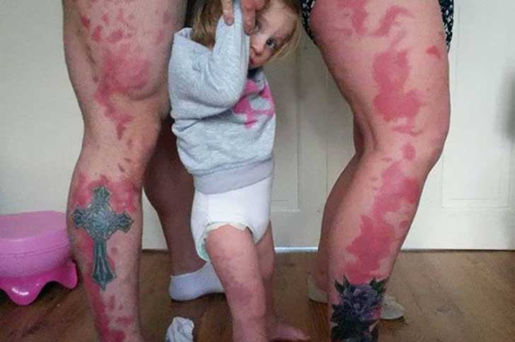 padres se tatúan marcas de nacimiento como las de su hija