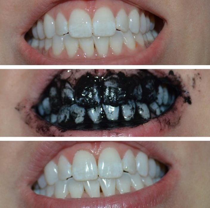dientes con carbón