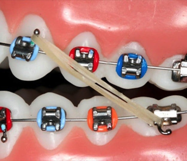 dientes con brackets y ligas