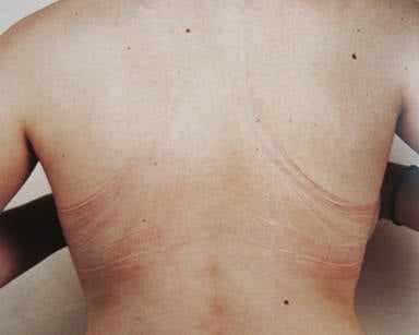 Espalda de una chica con marcas de sostén 