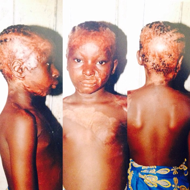 Niña de 9 años que sufrió quemaduras con aceite caliente, ahora es una artista del maquillaje 