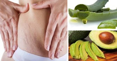 8 Remedios caseros que te ayudarán a difuminar esas molestas estrías