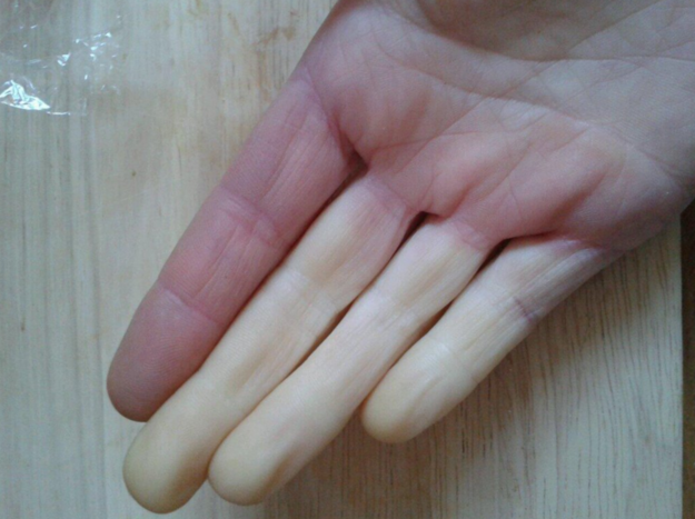 manos con sindrome de raynaudn