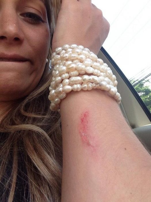 mujer con raspón en brazo