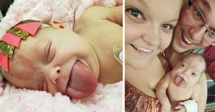 Nació con la lengua del tamaño de un adulto y pudo sonreír por primera vez después de una cirugía