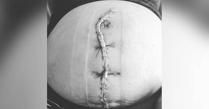 Mamá comparte fotografía de su gigantesca cicatriz de cesárea para darle una lección al mundo