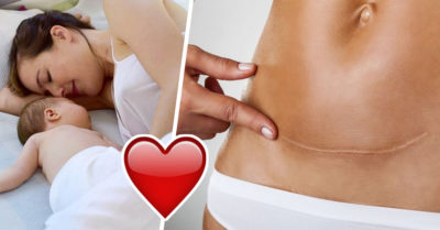 3 Verdades que solo las mujeres que vivieron un parto por cesárea entenderán
