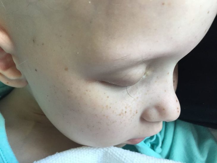 niña sin cabello con cancer tiene una pestaña pequeña 