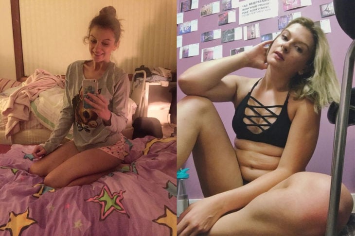 Chica en un antes y después de superar la anorexia 