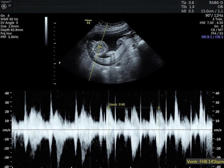 Ultrasonido bebé a la que iban a donar sus órganos 