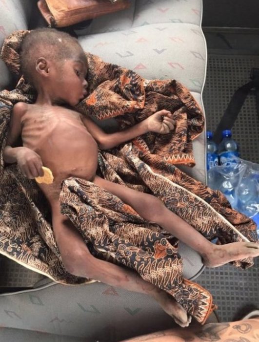 Niño de Nigeria sufriendo desnutrición 