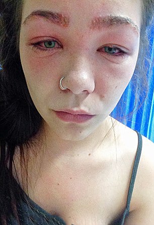 Chica sufrió reacción alérgica a un tinte para cabello 