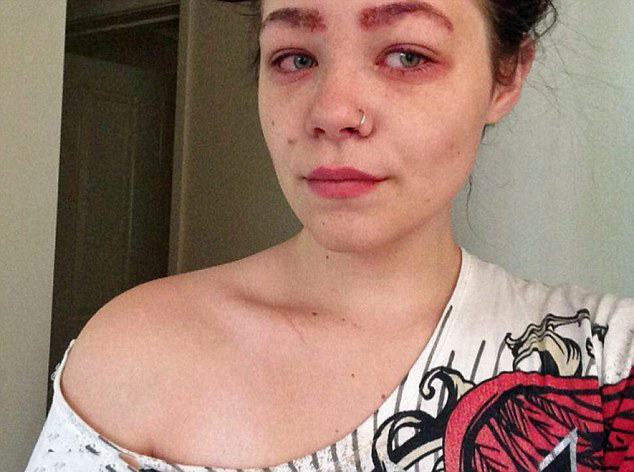 Chica sufrió reacción alérgica a un tinte para cabello 