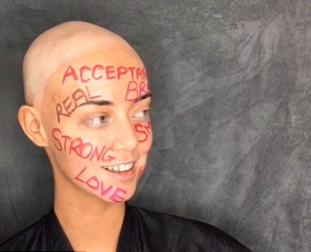 Chica que sufre de alopecia 