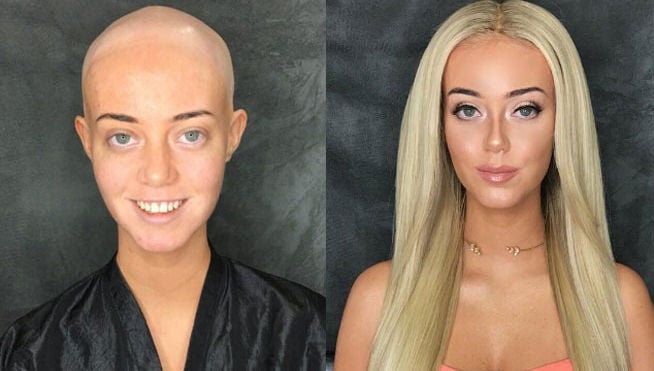 Chica que sufre de alopecia  
