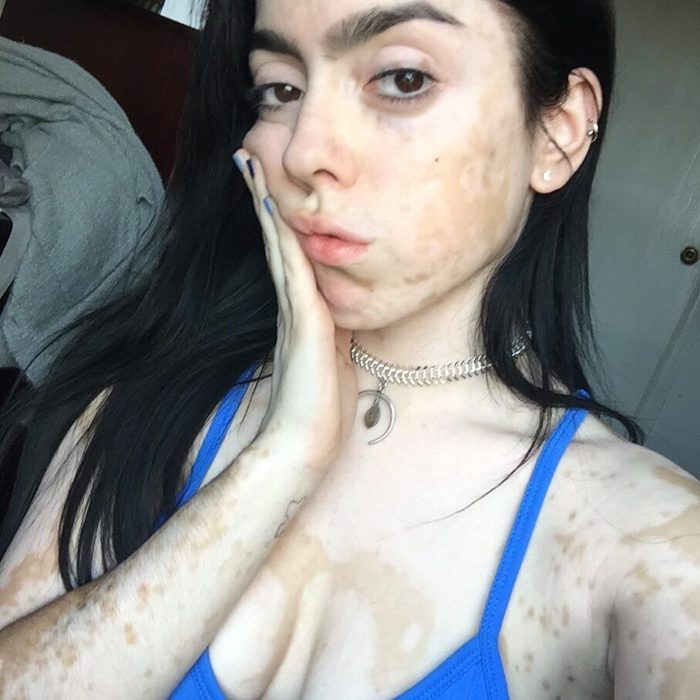 Chica que sufre de Vítiligo 