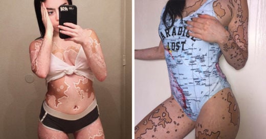 Se burlaban de ella por tener vitiligo, así que convirtió su cuerpo en un lienzo