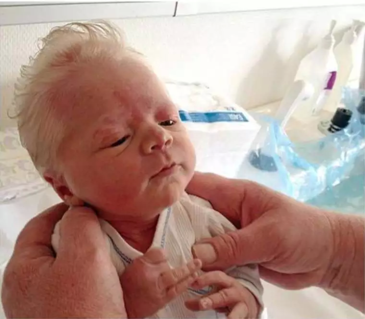 bebé albino