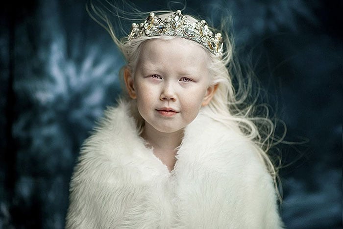 Niña albina posando para un fotógrafo 