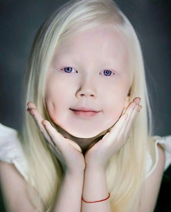 Niña albina posando para un fotógrafo 