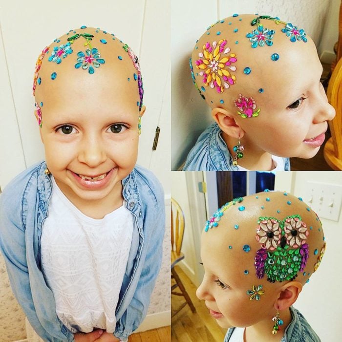 niña con alopecia