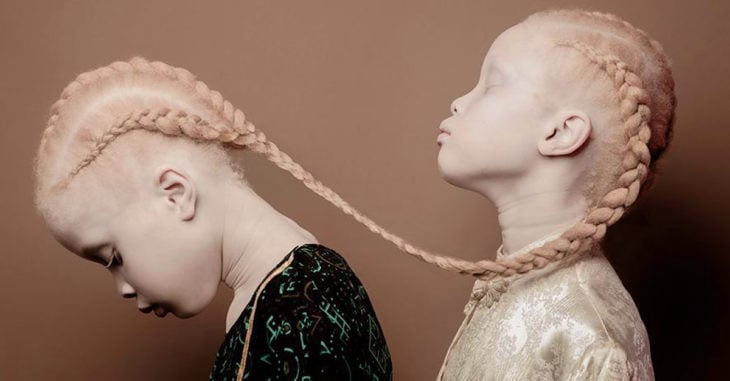 Conoce a las gemelas albinas que están impactando al mundo