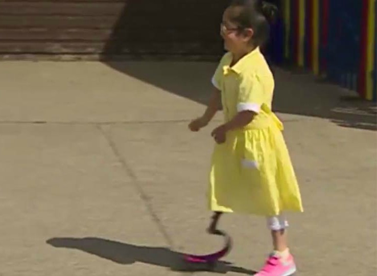 niña con protesis vuelve a la escuela