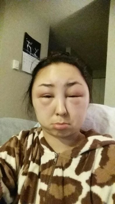 Chica que sufrió de una reacción alérgica 