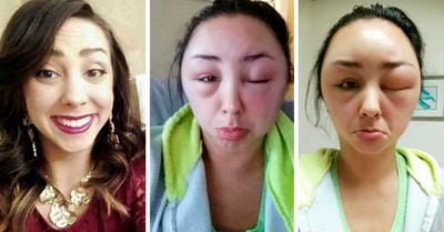 Chica con reacción alérgica al tinte te recordará por qué SIEMPRE debes hacer una prueba previa