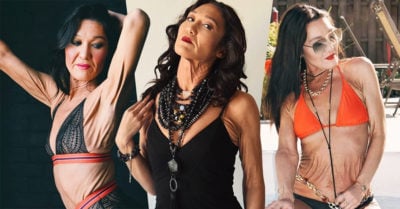 Tiene 26 años y el cuerpo cubierto de arrugas por una rara enfermedad; es un ejemplo de amor propio