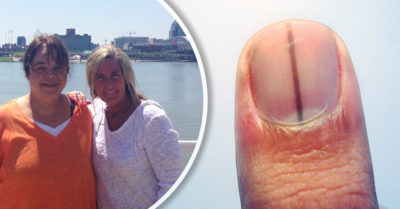 Descubrió que tenía cáncer por una franja inusual en su uña; su manicurista le dio la alerta