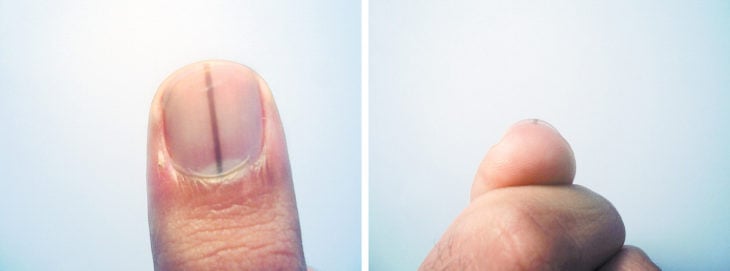 tipo de cáncer lineal en las uñas 