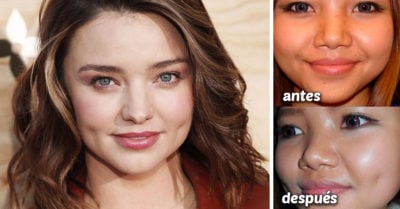 Dimpleplasty, la cirugía de hoyuelos en las mejillas que ya es toda una moda millennial