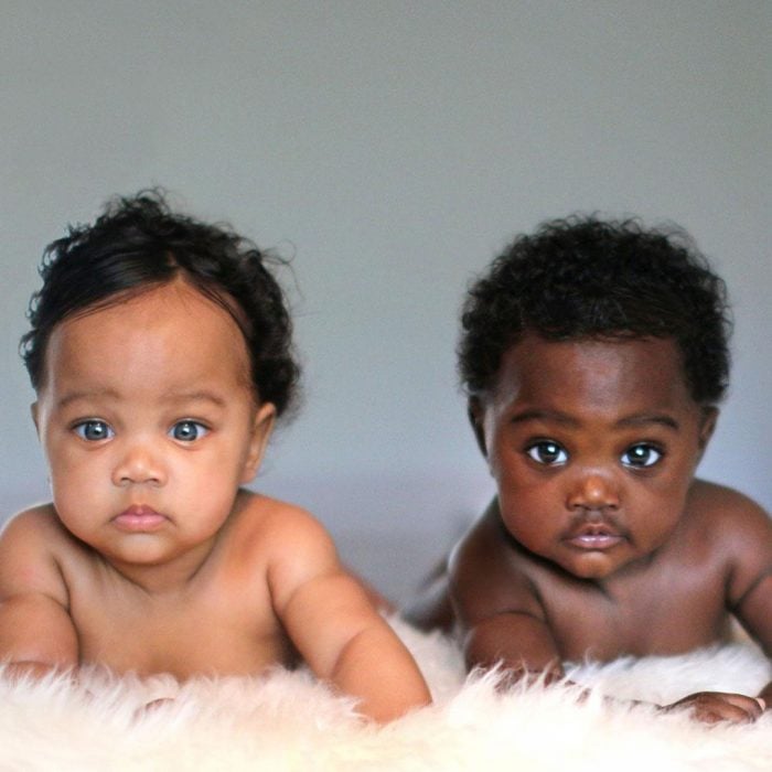 Gemelas que nacieron con un increíble color de piel diferente 
