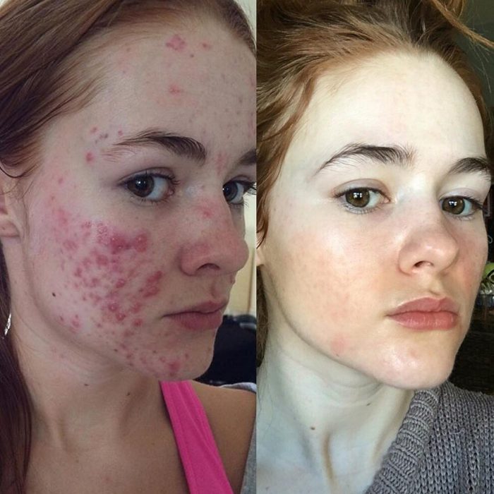 Chica con acne 