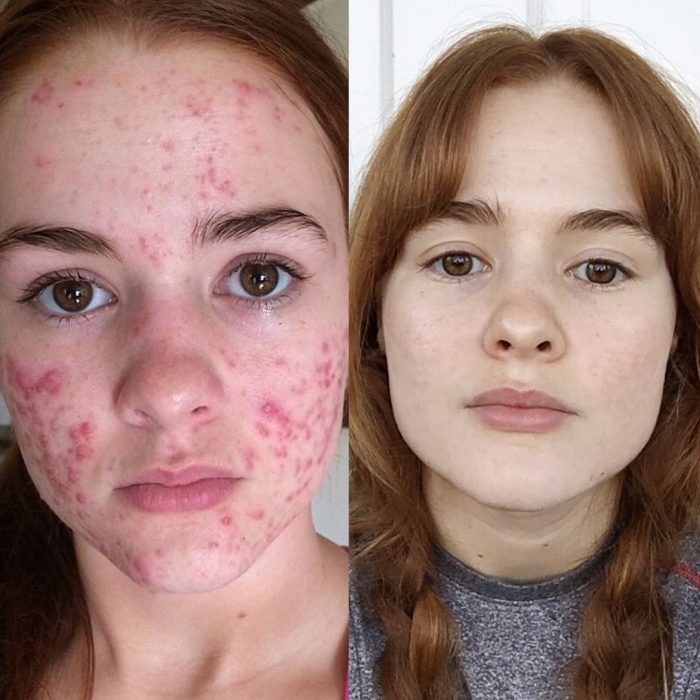 Chica con acne 