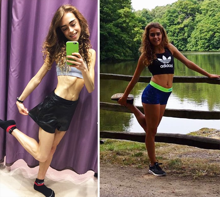 Personas antes y después de superar la anorexia 