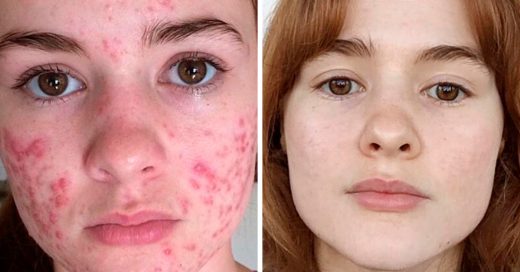 Esta chica ha mostrado su antes y después del acné; el cambio es increíble