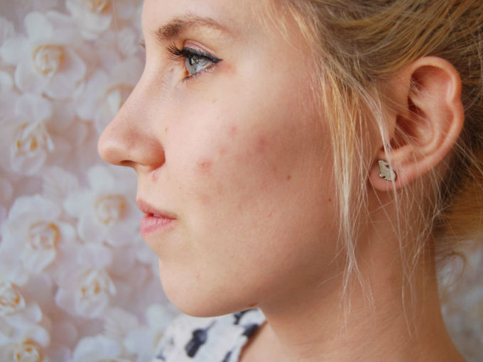 3 tipos de cicatrices que el acné puede dejar en tu piel